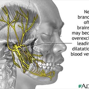 Headache Upon Standing - What Does A Migraine Aura Look Like?