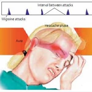 Migraine Neurological Disease And Therapy - Take Fioricet To Relieve Your Headache 
